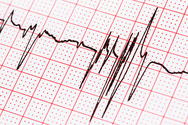 EKG Nedir