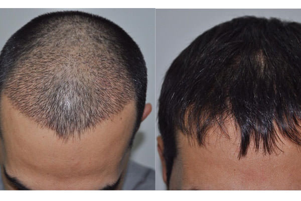 what is hair transplantation