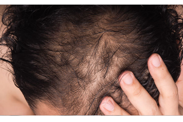 what is hair transplantation