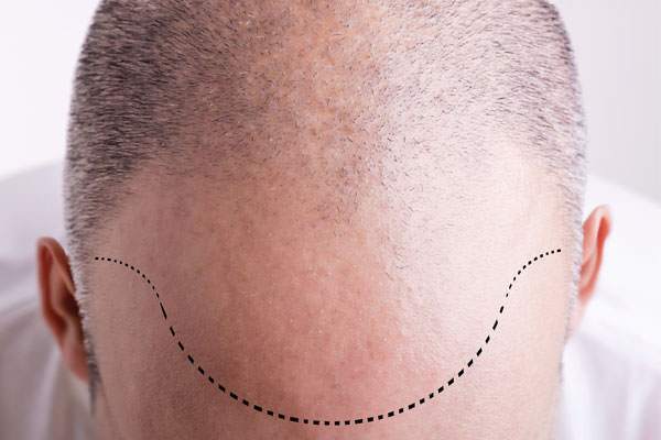 what is hair transplantation