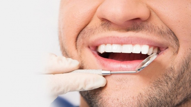 Dental Veneers