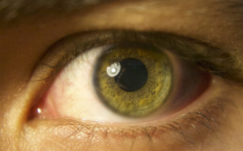 Diyabetik Retinopati