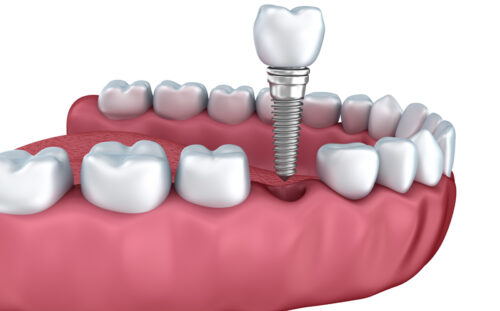 Implant