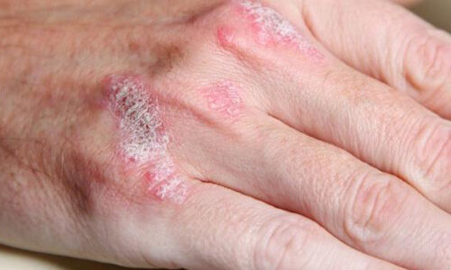Psoriasis (Sedef Hastalığı)