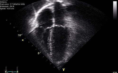 Echocardiography