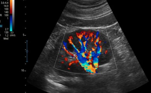 Color Doppler Ultrasonography