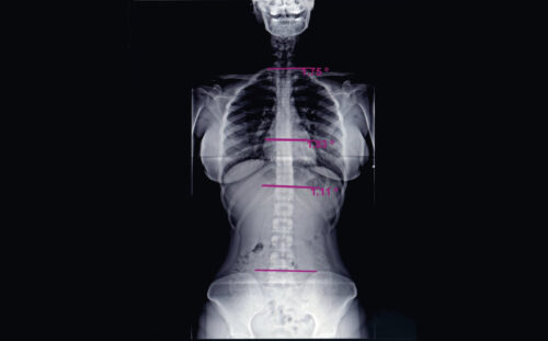 Digital X-Ray
