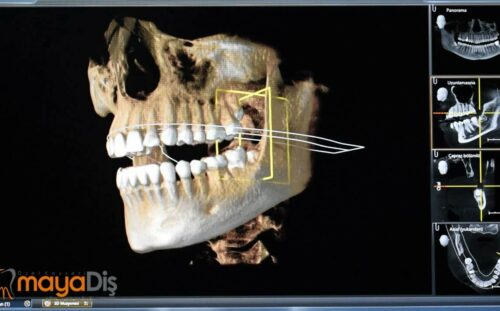 Diş Tomografisi: Ağız ve Çene Sağlığında 3D Görüntüleme Devrimi